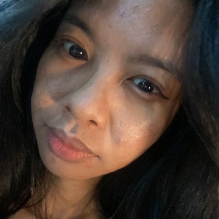 Accingg🐣 | Acne Prone skin