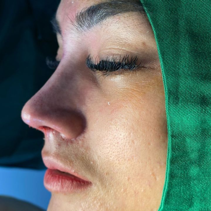 Rhinoplasty Jakarta (RJ)