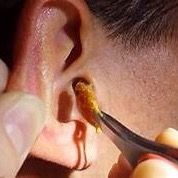 Take earwax 999