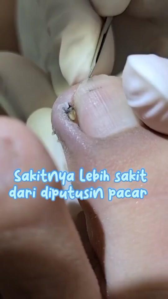 Sakitnya lebih sakit dari diputusin pacar! #kukucantegan #caramembersihkankuku #bersihinkukukaki #guntingkuku #guntingkukuviral 
