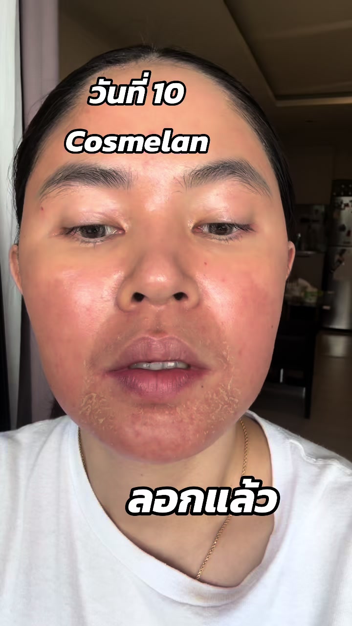 รีวิววันที่ 10 ลอกแล้ว #cosmelan #รักษาฝ้า #ผลัดเซลล์ผิวเก่า #เวชสําอาง 