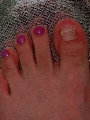 El enlace esta aqui👆🇺🇸#nailfungustreatment 