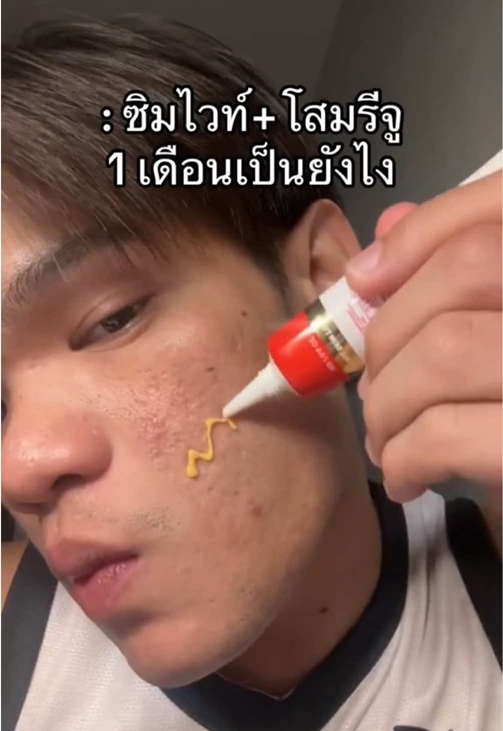 จากการใช้มาเกือบ 1 เดือนคือดีย์!!   #ครีมลดรอยฟาวเดอร์ #ครีมซิมไวท์377 #ละลายสิว #ละลายสิวฟาวเดอร์ #ฟาวเดอร์สกิน #founderskin