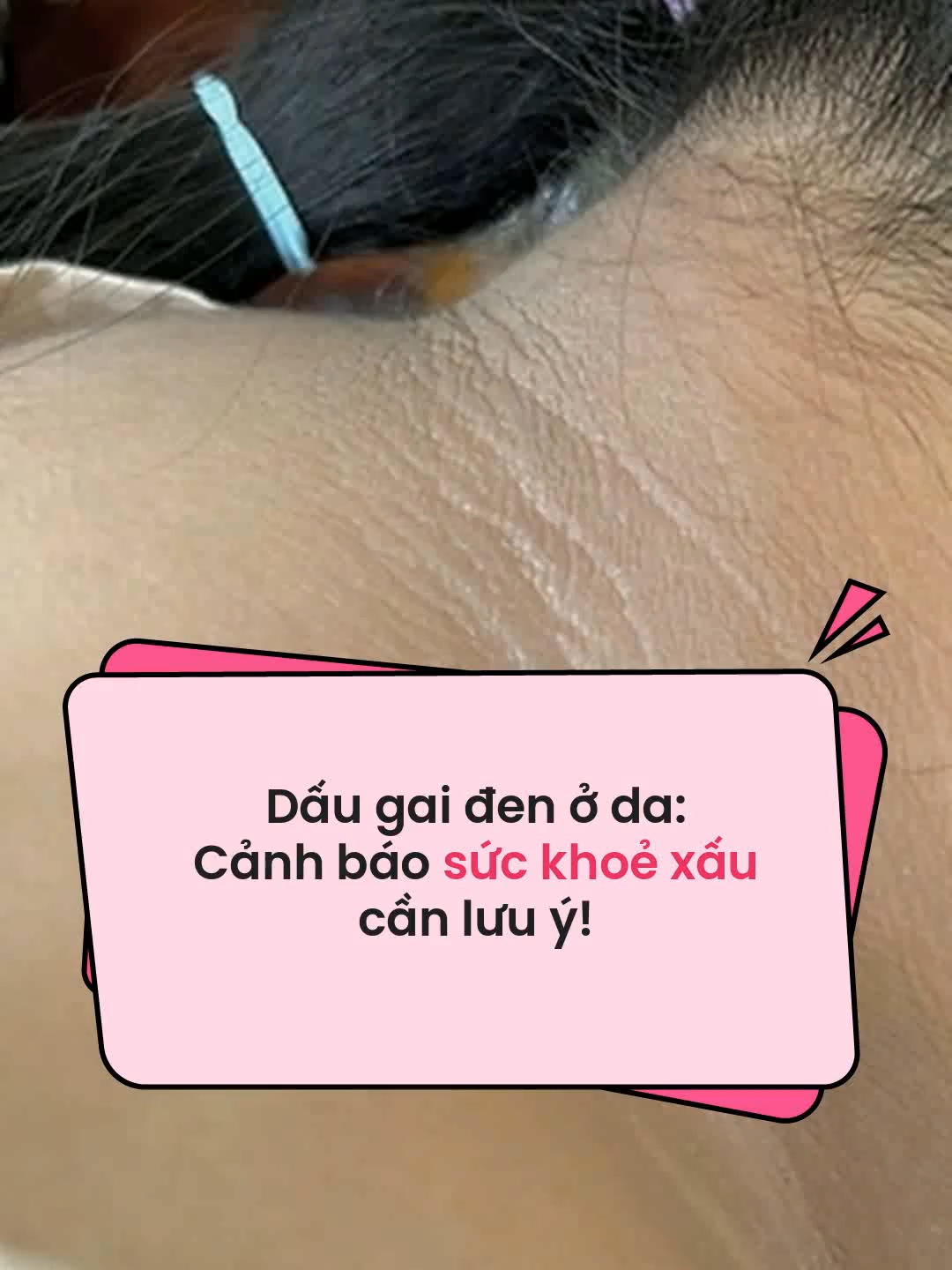 Dấu gai đen ở da cảnh báo sức khỏe #gaiden #suckhoe #aFamilyNgayLucNay #TikTokNews #amm #SocialNews #detox