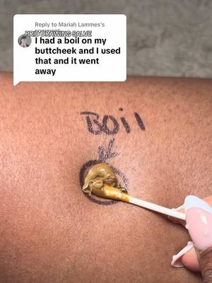 Replying to @Mariah Lammes this salve is amazing for boils, bug bites, splinters and more! #prid #drawingsalve #salve #splinterremoval #cysticacne #pridsalvecysticacne #pridsalve #boilrelief #skincare #skintips #painrelief #painrelief #cuts #ingrowns #ingrownhairs #ingrownremoval #ingrownrelief #boil #boilremoval 