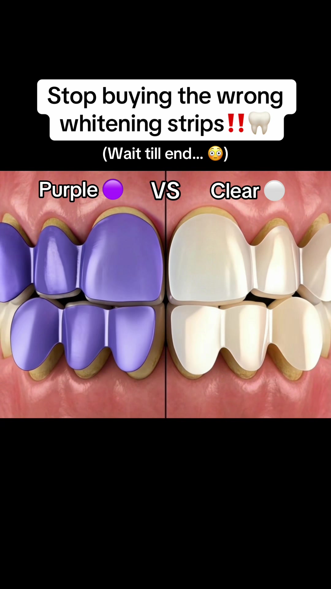 The results are genuinely insane! ✨😳🦷 #yellowteeth #teethwhiteningstrips #whiteningstrips #tiktokmademebuyit #teethwhitening 