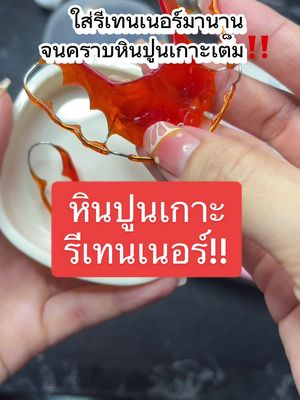 คราบหินปูนเกาะรีเทนเนอร์ล้างออกได้#เม็ดฟู่คู่รีเทนเนอร์ #เม็ดฟู่ทําความสะอาดรีเทนเนอร์ #เม็ดฟู่ทําความสะอาดฟันปลอม #เม็ดฟู่คู่ใจรีเทนเนอร์ #เม็ดฟู่ล้างรีเทนเนอร์ 
