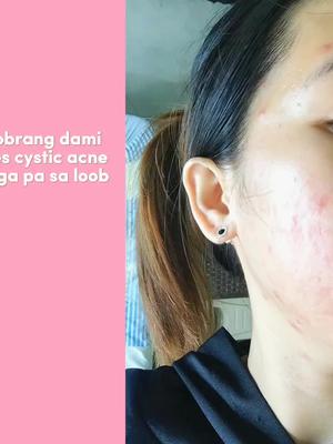 HONEST GLOW GLOW UP JOURNEY,. TRY MUNA DIN, kung ikaw ay nakakaranas ng acne or pimples na sobra mong kinakahiya baka gaya ko mahiyangan mo din to 🥰💗✨️#honestglow #honestglowkojic #honestglowkojicpapayasoap #honestglowglassskinsoap #honestglowaloeicetoner #honestglowtintedsunscreen #honestglowfragrancefreesunscreen #honestglowfacialrejuvset #honestglow24kgoldpapayaserum #honestglowglassskinserum #honestglowbydavevillanueva #fyp #fypシ゚viral #foryoupage #tiktokfinds #tiktokphilippines #buynow @ankrizzie @dave_villanueva