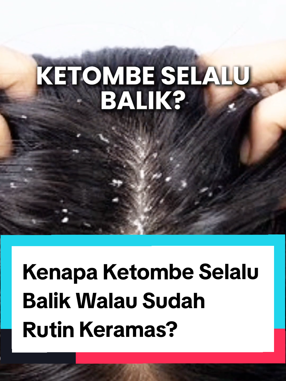 Kulit kepala juga butuh perlindungan lho! Scalp barrier (lapisan pelindung alami di kulit kepala) bisa rusak akibat banyak hal dan kamu jadi rentan berketombe. Gunakan shampoo dengan kandungan bahan aktif yang tepat misal 10x niacinamide untuk scalp barrier kuat dan tahan banting melawan ketombe! #creatorsearchinsights  #belajarbarengdraudrey  #draudreynatalia  #longervideos  #scalpdermaexpert #clearlytahanbanting #scalpbarrierkuat  @clearindonesia 