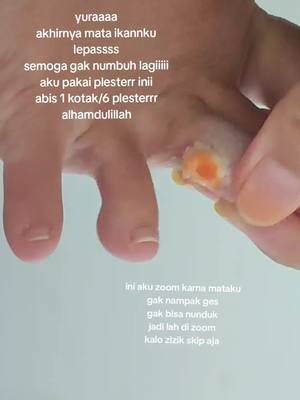 #plester #plestermataikan #mataikan bye mata ikan alhamdulillah masyaallah tabarakallah smoga gak muncul lagii