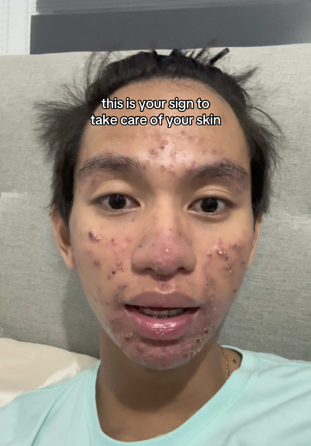 literal na miracle ang nangyari 😭❤️ #acaiberryjuice #glowingskin #acaiberry #acaiberryjuicedrink #pimples #acne #severeacne 