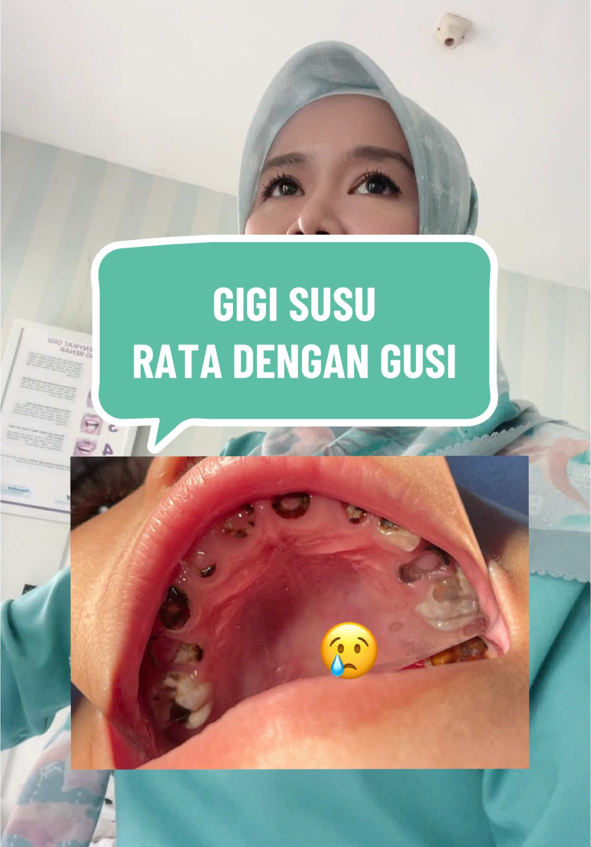 Tidak boleh mencabut gigi susu terlalu cepat #LIVEhighlights #TikTokLIVE #LIVE #drgnihlah #dentist #doktergigi #lovetiktok #drgmalang #malanghits #malang #gigi #drg #dr #livetiktok #gigisusu #sisaakar #edukasi 