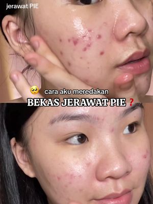 bekas jerawat PIE kok susah hilangnya???? emang susah, beneran PR BGT & harus extra sabar. 🥹👌🏻 cara aku meredakan PIE adalah basic hydrating skincare yg fokus di soothing & calming, dibantu skincare yg ada kandungan Tranexamic Acid itu paling ngaruh di PIE aku. kalo ditanya moisturizer calmingnya apa? aku bakalan rekomendasiin moist acnaway mugwort water gel ini, yg sekaligus bantu ngeredain pas lg ada jerawat meradang. harganya pun masih kantong pelajar friendly! cuma 30ribu-an aja 👌🏻💖 worth to try! #bekasjerawat #PIE #jerawatpie #moisturizer #rekomendasimoisturizer #mugwort #acneskincare