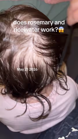 If your hair isn’t growing, watch the end of this video. Couldn’t be more grateful for this product it has genuinely helped my family. I hope this can help someone else . We are not all the same so I can’t make promises that it will work for you, but It did work for my daughter and me.❤️ #hairloss #hairgrowthjourney #dealsforyoudays #paratiiiiiiiiiiiiiiiiiiiiiiiiiiiiiii #healthtok 
