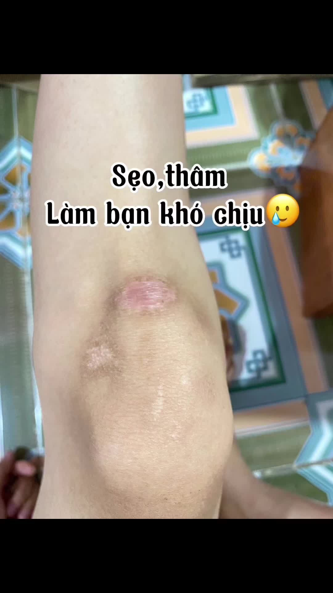 Gel làm mờ sẹo Dermatix Ultra 15g #kemtriseo #lammoseo #triseo #dermatix #dermatixultra #moseo 