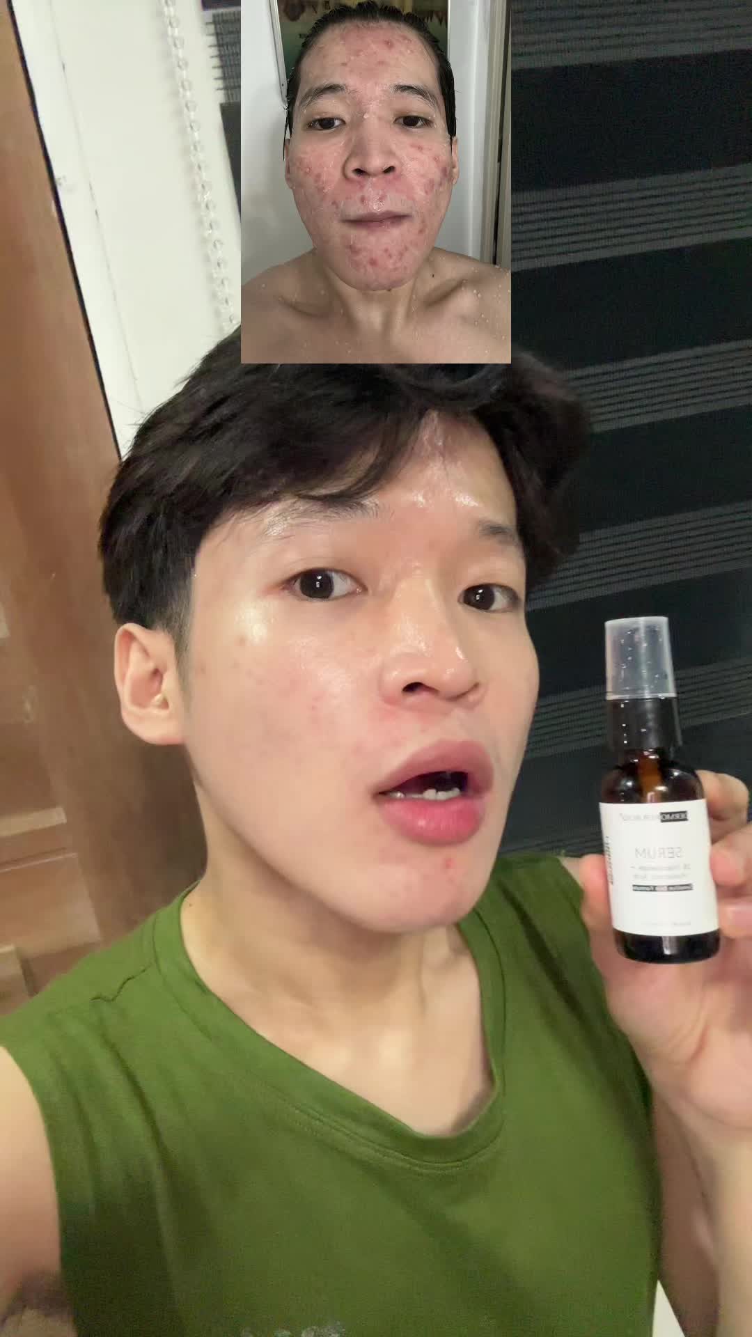 Kung may pimples ka gamitin mona serum nato  #dermorepubliq #dermorepubliqserum #pimples #skincarerecommendations 