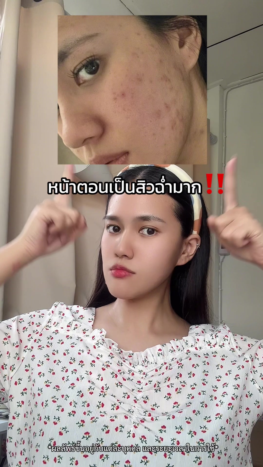 กว่าจะผ่านมาได้‼️ เราดูแลปัญหารอยสิวด้วยตัวนี้เลย #จุฬาเฮิร์บ #เซรั่มมะรุมเปปไทด์ #เซรั่มลดรอยสิว #รอยสิว #ผิวชุ่มชื้น #acnelabseries 