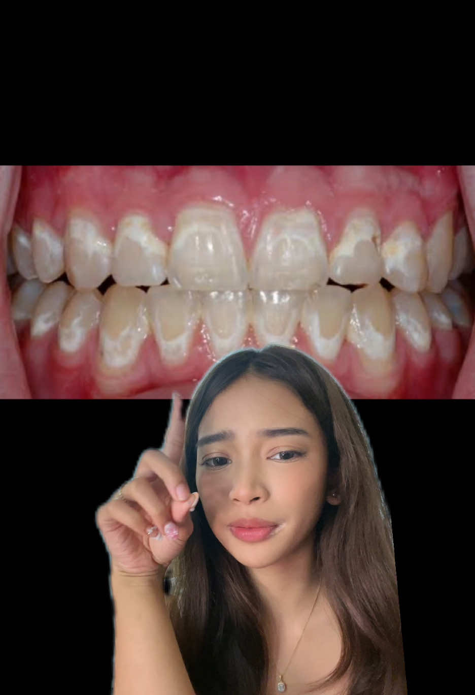 Here’s my tip if you have/want braces!! #braces #orthodontics #toothbrush 