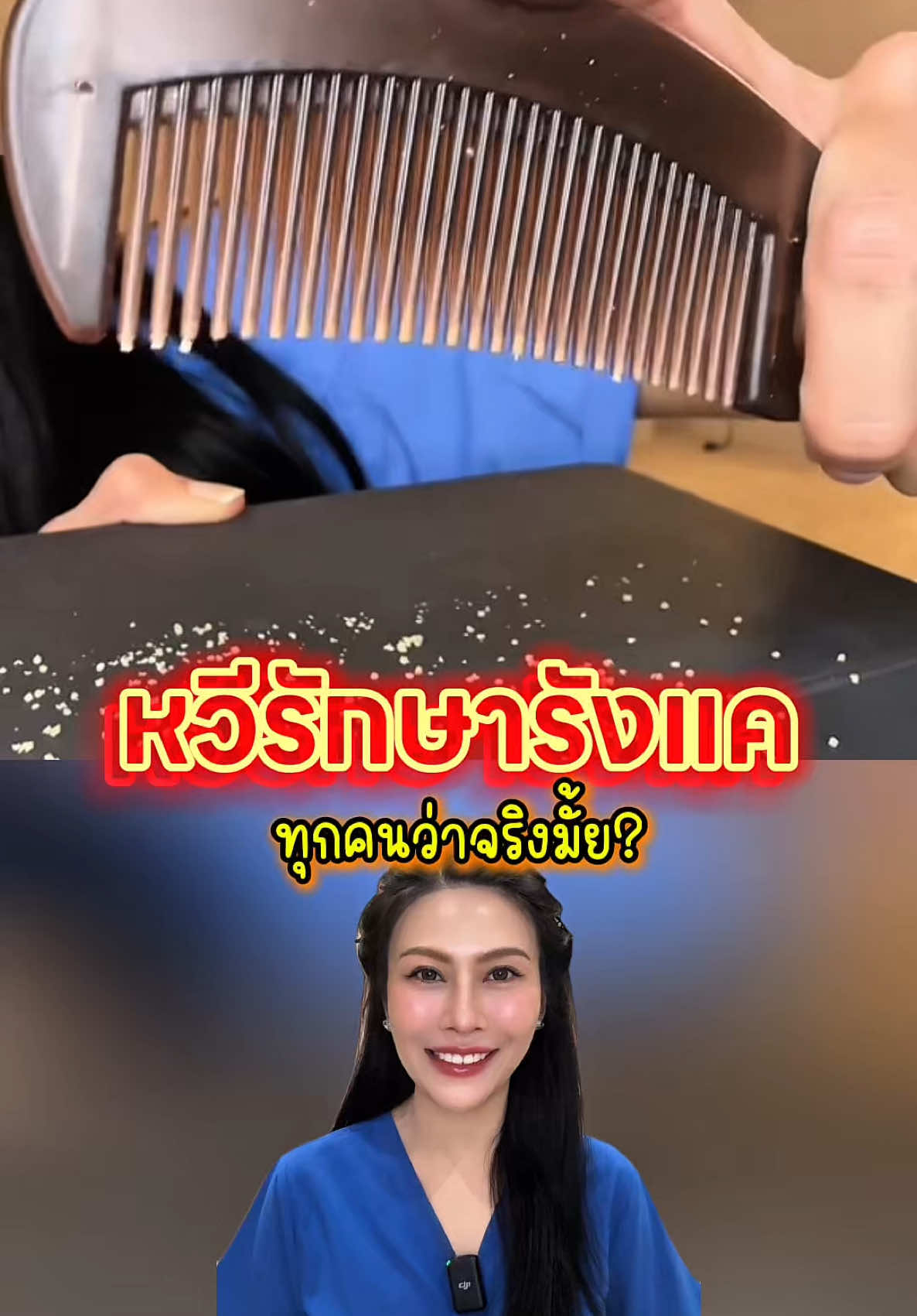 หวีรักษารังแค? #รังแค #คันหัว #สระผม #เปลี่ยนมาใช้เซลซั่นบลู #เห็นผลจริงใน2สัปดาห์ #ถ้าเขาทำเจ็บเซลซั่นบลูรับจบ #SelsunblueThailand #พยาบาลอัญ #Aunnyc 