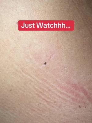 Watch this blackhead pop right out of my boyfriends back 👀 using the Dr. Melaxin Peel Shot!  #drmelaxin #blackheadremoval #peelshot  #blackheadpop #porecleanse  #oddlysatisfying @Dr.Melaxin Global 