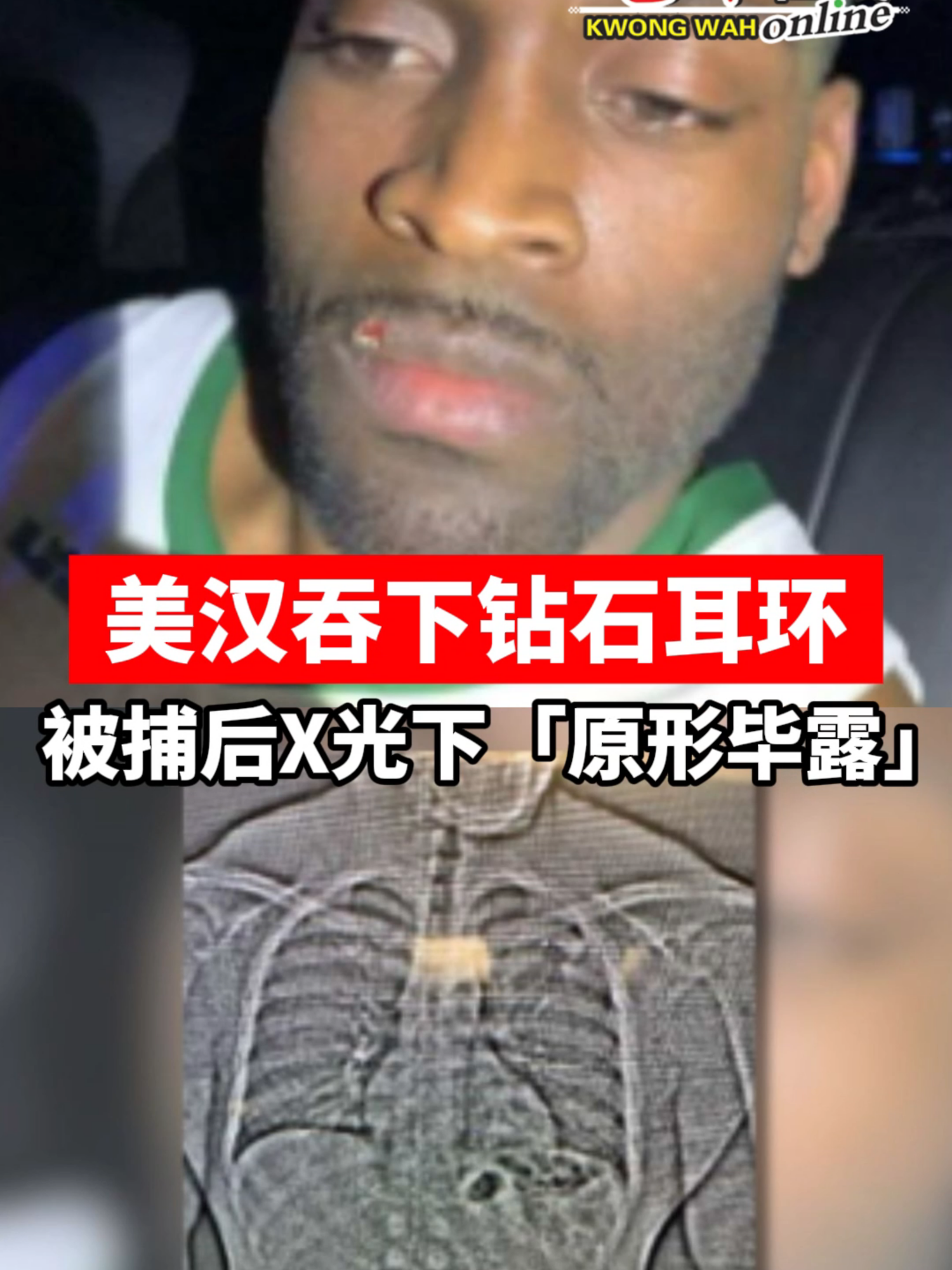 抢了钻石耳环吞下肚 X光下依然难逃法眼 #光华日报 #光华报动 #BeritaDiTiktok #NewsAtTiktok #TikTok新闻 #TrendingNewsMalaysia