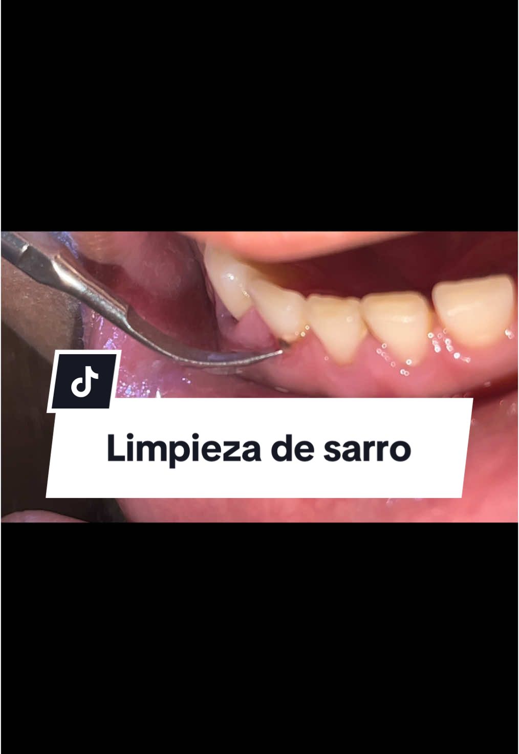 Fácil de retirar el sarro de tus dientes desde la comodidad de tu casa #dientes #dientesblancos #dientesblancos #dientessanos #tiktokshop #tiktokshopfinds #tiktokshopnewyearnewaura #tiktokshoplastchance #tiktokshopsanvalentinesday #limpieza #limpiezadental #remociondesarro #removersarro #limpiezadentalultrasonica #rechargeable 
