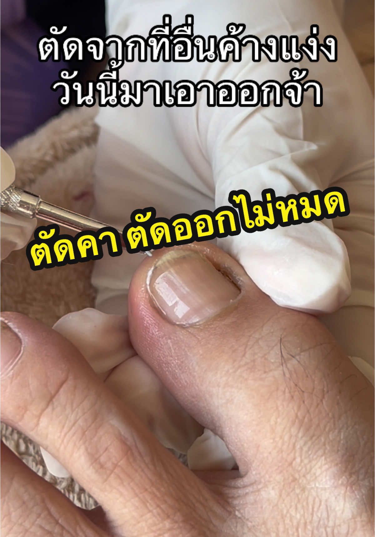 ค้างคาก้อต้องเอาออก #ร้านทำเล็บพิษณุโลกALLYE #ทำเล็บพิษณุโลกALLYE #เทรนด์วันนี้ #nai #nails #nails #วิถีช่างทําเล็บ💅💓 #ร้านดีบอกต่อ #ตัดเล็บขบพิษณุโลก #อุปกรณ์ทำเล็บ #nailartist #ตัดเล็บขบพิษณุโลก #ตัดเล็บขบมียาชา #ลายเล็บเจลสวยๆ #ร้านทําเล็บใกล้ฉัน #เล็บขบโหดๆ #ขบหนอง #เล็บขบ 