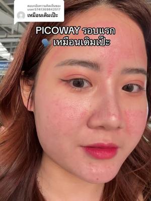 ตอบกลับ @user5741369842517  แกต้องดูดีๆ ช่วงรอยแก้มล่างเป็นรอยเส้นเลือดนะแก  #picoway #picowaylaser #กังนัมคลินิก 